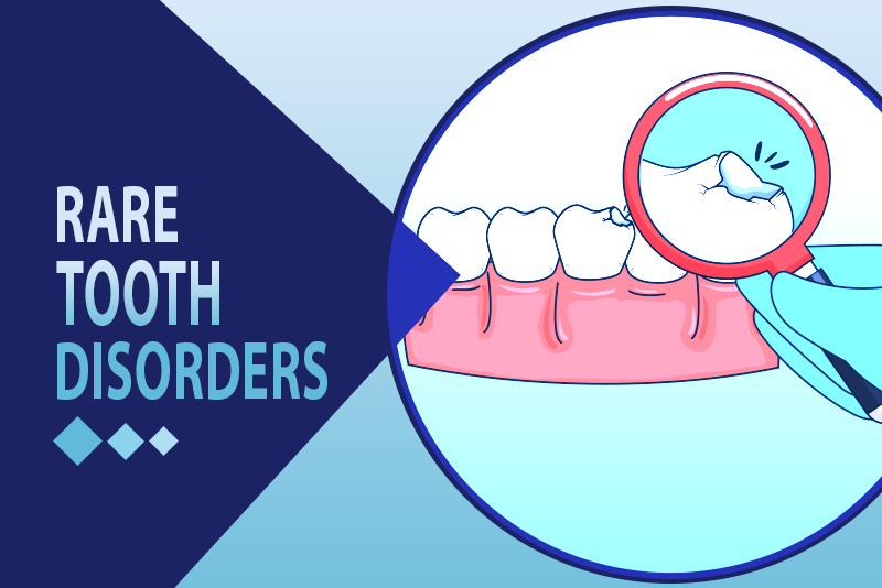 ICD-10 Codes for 11 Rare Tooth Disorders