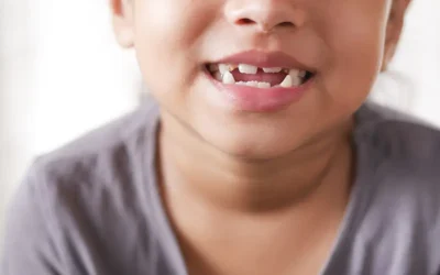 What Are the ICD-10 Codes to Report Tooth Developmental Disorders?