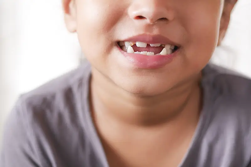 What Are the ICD-10 Codes to Report Tooth Developmental Disorders?