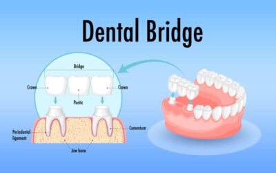 Cracking the Code: Understanding CDT Codes for Dental Bridges
