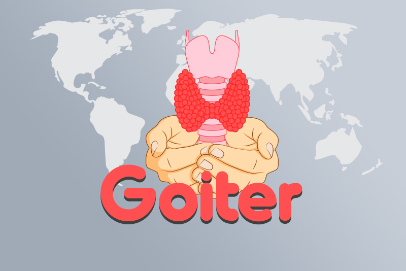 Goiter – Symptoms, Causes and Diagnosis Codes