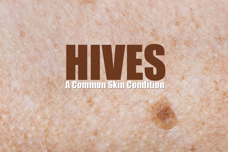 Report Hives on Your Medical Claims