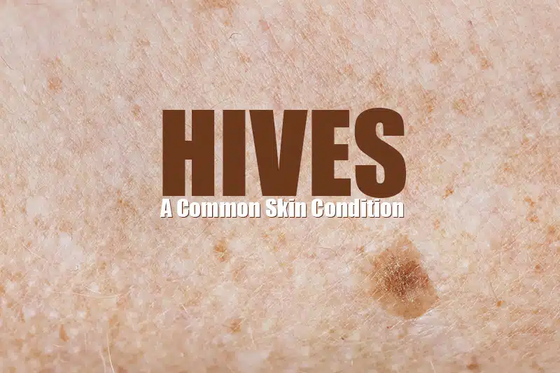 Report Hives on Your Medical Claims