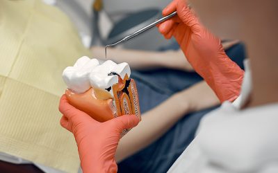How to Bill and Code for Root Canal Procedures
