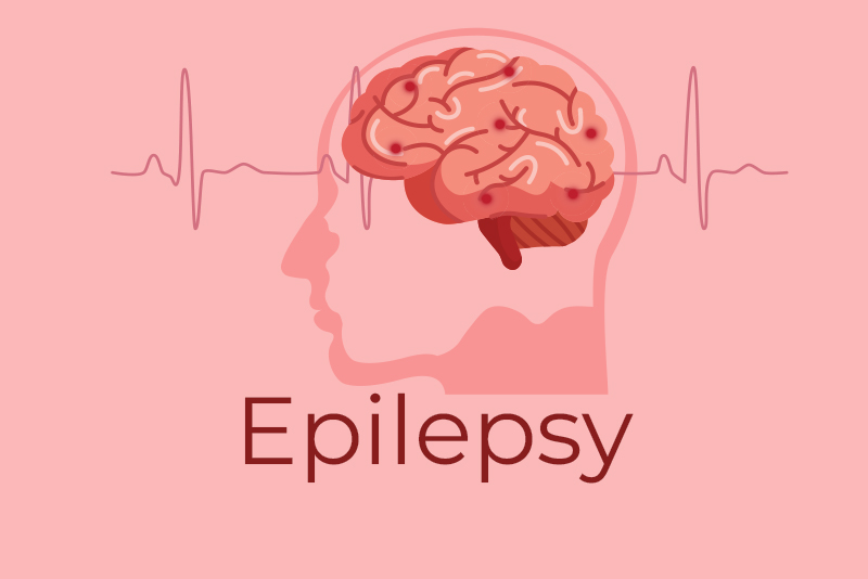 Bill and Code for Epilepsy Surgery