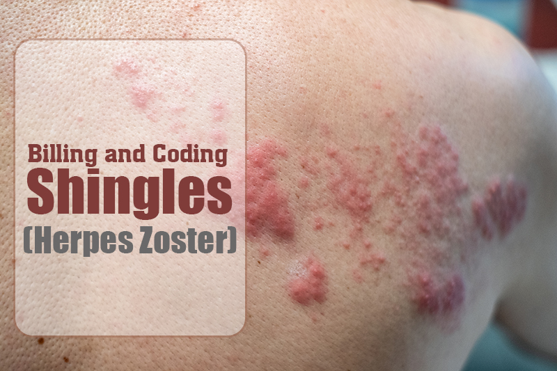 Billing and Coding for Shingles Herpes Zoster