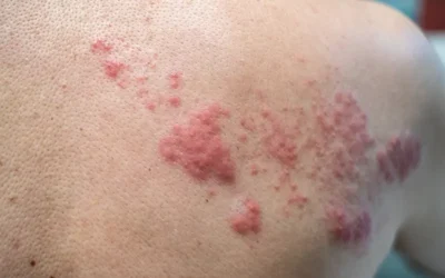 ICD-10 Codes to Report Shingles (Herpes Zoster)