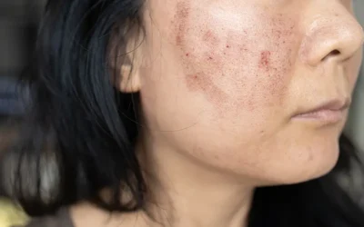 How to Code for Systemic Lupus Erythematosus (SLE) – An Autoimmune Disorder
