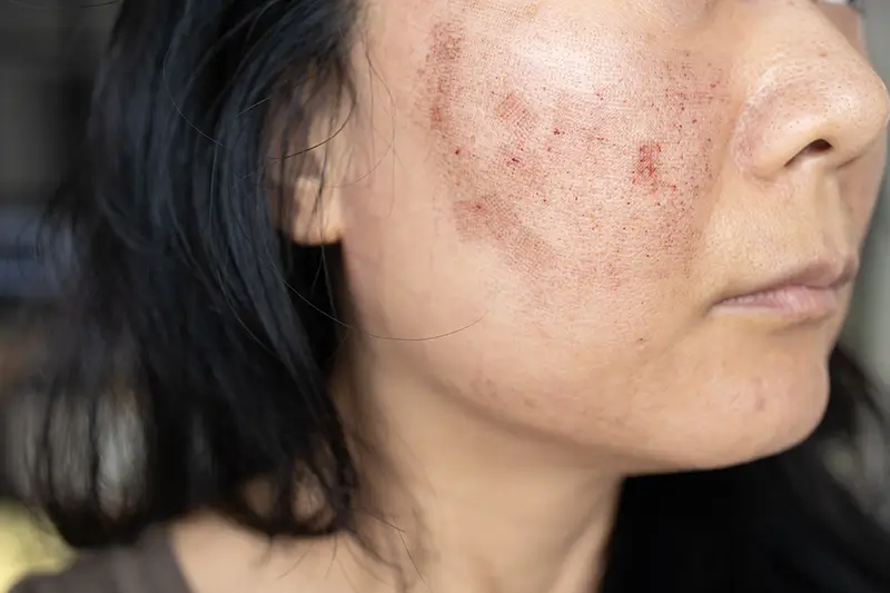 How to Code for Systemic Lupus Erythematosus (SLE) – An Autoimmune Disorder