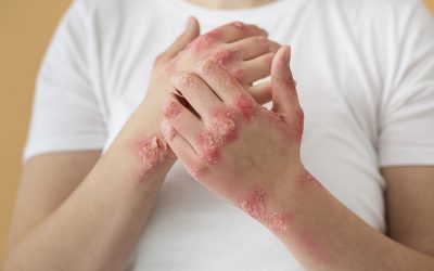 Coding Dermatitis – An Overview of the Symptoms and ICD-10 Codes
