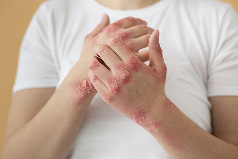 Codes to Report Dermatitis