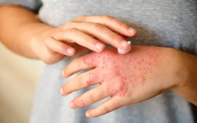Coding Dermatitis – An Overview of the Symptoms and ICD-10 Codes