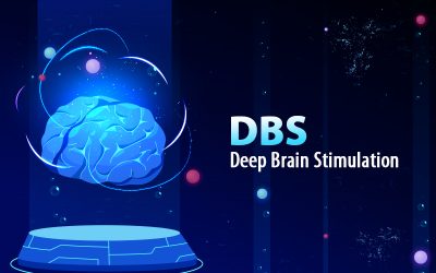 Billing and Coding for Deep Brain Stimulation (DBS) Surgery