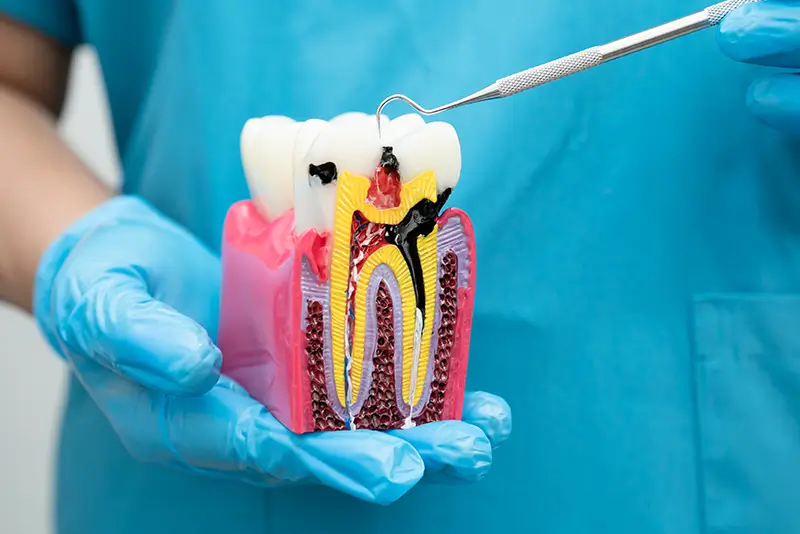 Navigating Root Canal Billing