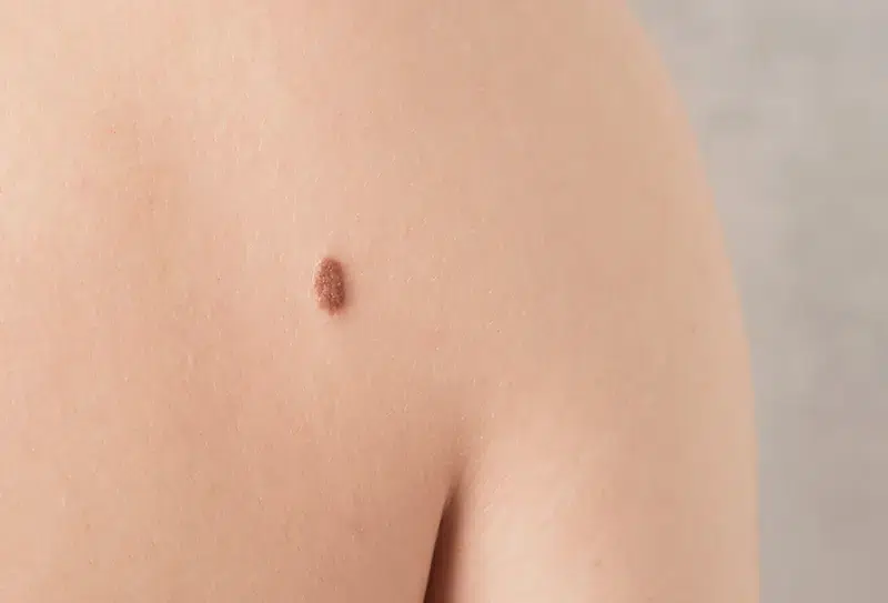 ICD-10 Codes for Basal Cell Carcinoma – A Common Type of Skin Cancer