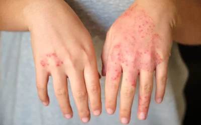How to Code for Dermatomyositis – A Common Rheumatology Disorder