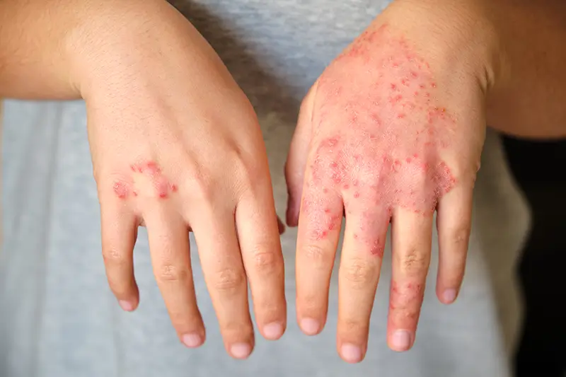 How to Code for Dermatomyositis – A Common Rheumatology Disorder