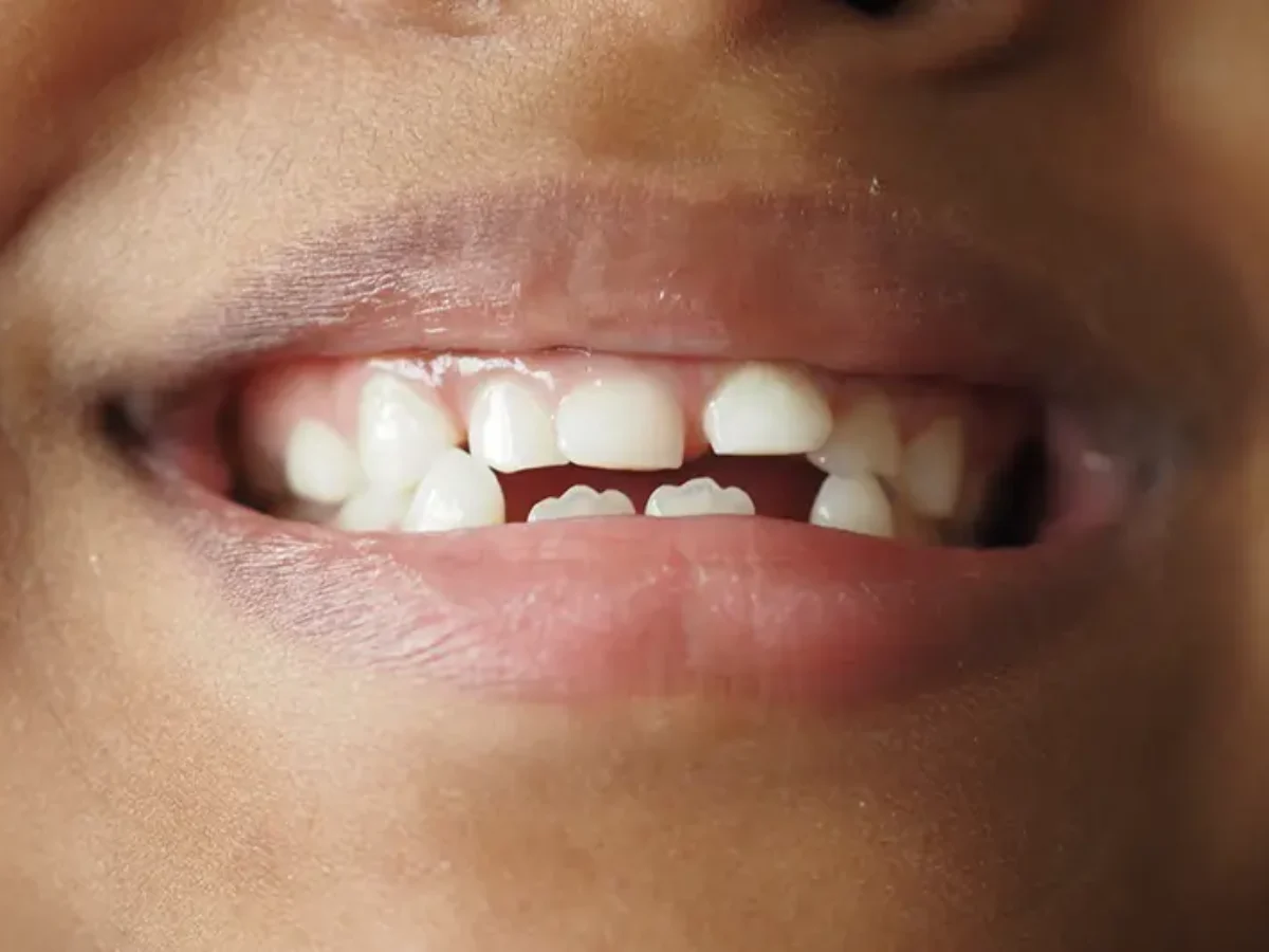 Clinicopathological and molecular insights into odontogenic tumors  associated with syndromes: A comprehensive review, image size:1200x900